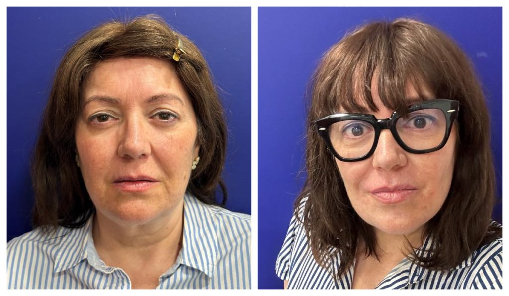 Antes y después de un rejuvenecimiento facial con neuromoduladores y ácido hialurónico, sin maquillaje ni retoques.